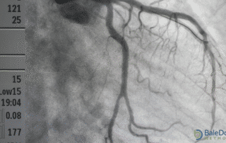 How serious is an angiogram