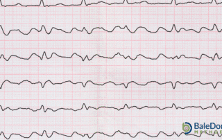 Controlled vs Uncontrolled Atrial Fibrillation
