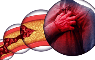 Hypertension Heart Disease and Stroke Related