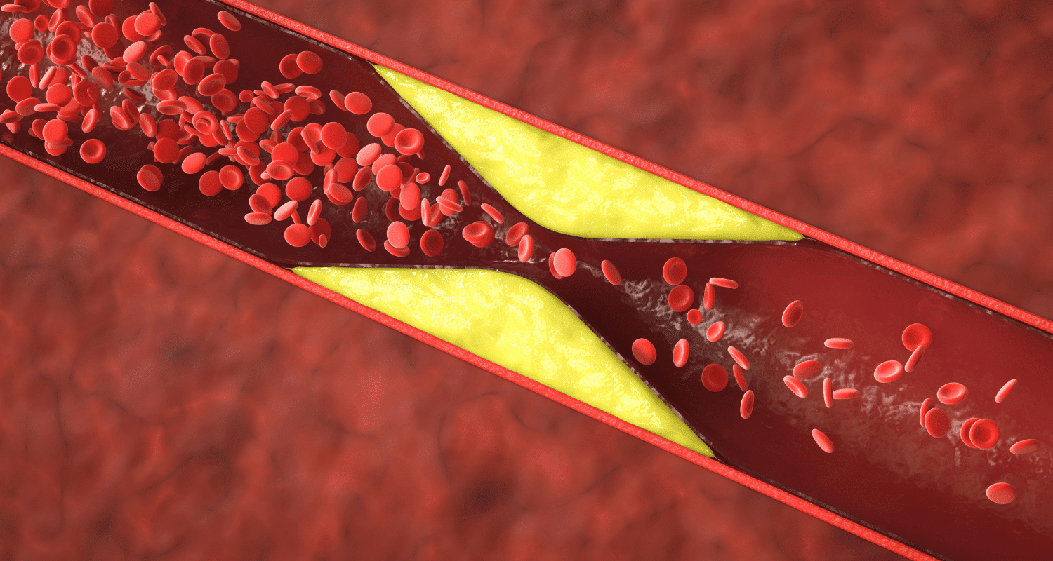 CRP Test vs Cholesterol Test for Heart Disease Risk