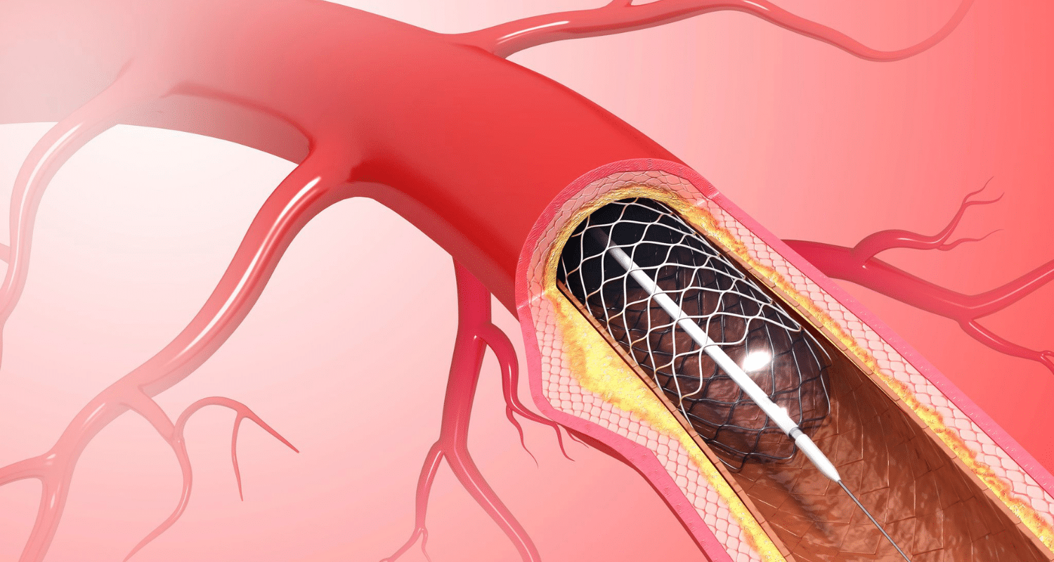 Coronary Stents