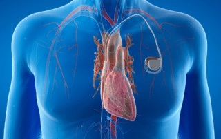Does A Pacemaker Prevent A Heart Attack