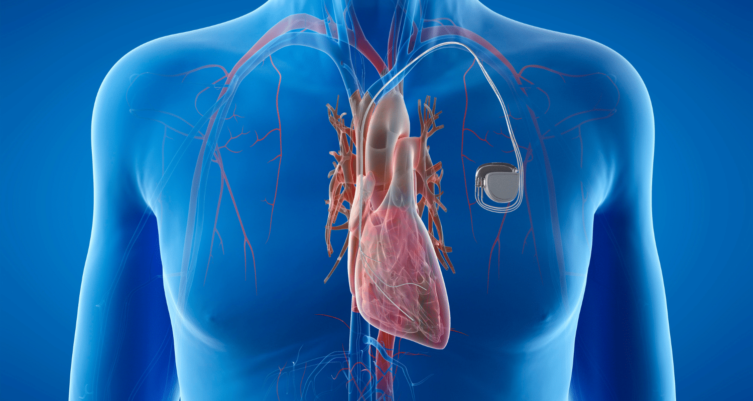 Does A Pacemaker Prevent A Heart Attack