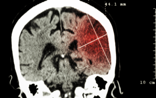 How to Prevent Stroke After TIA