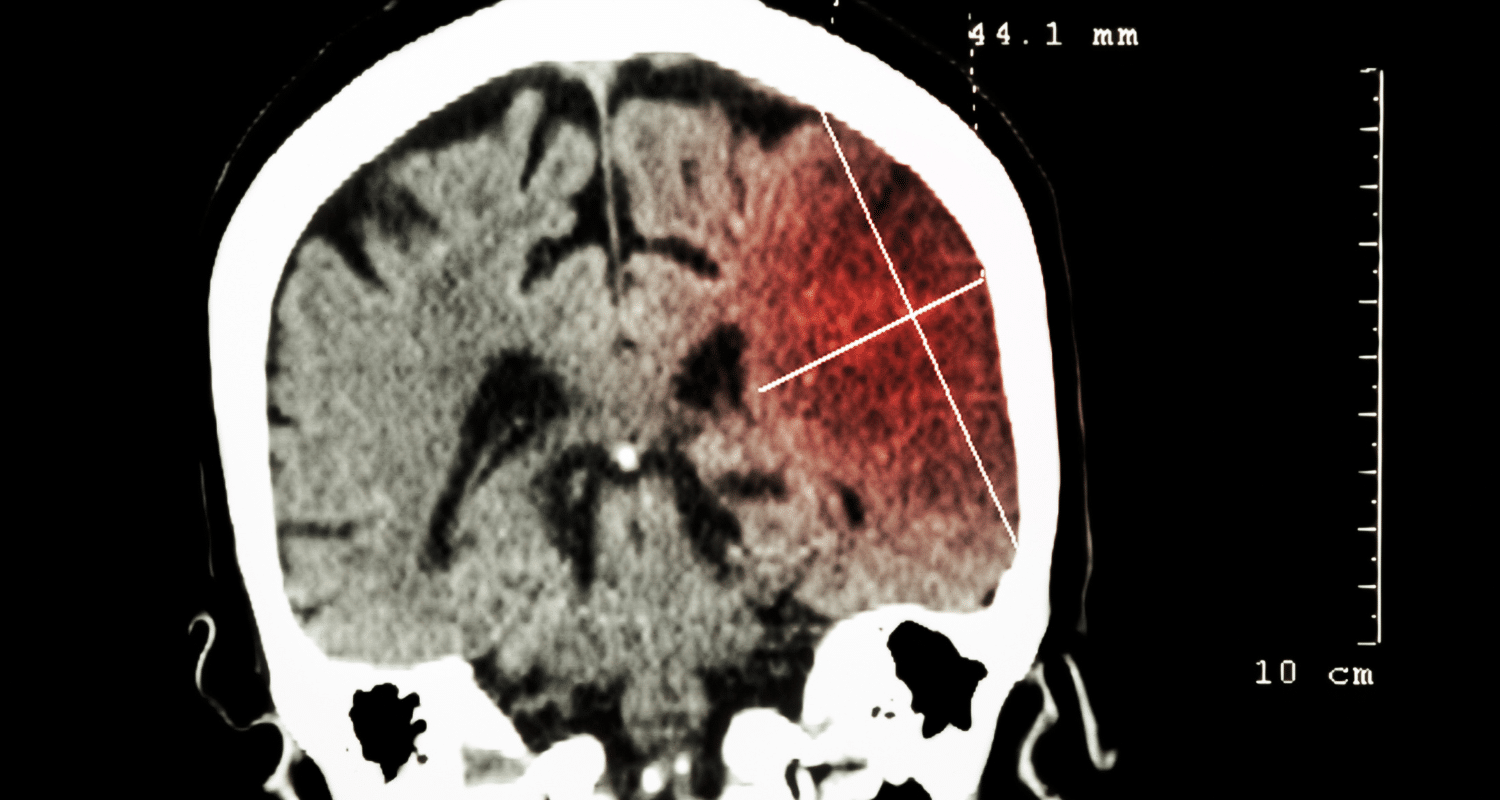 How to Prevent Stroke After TIA