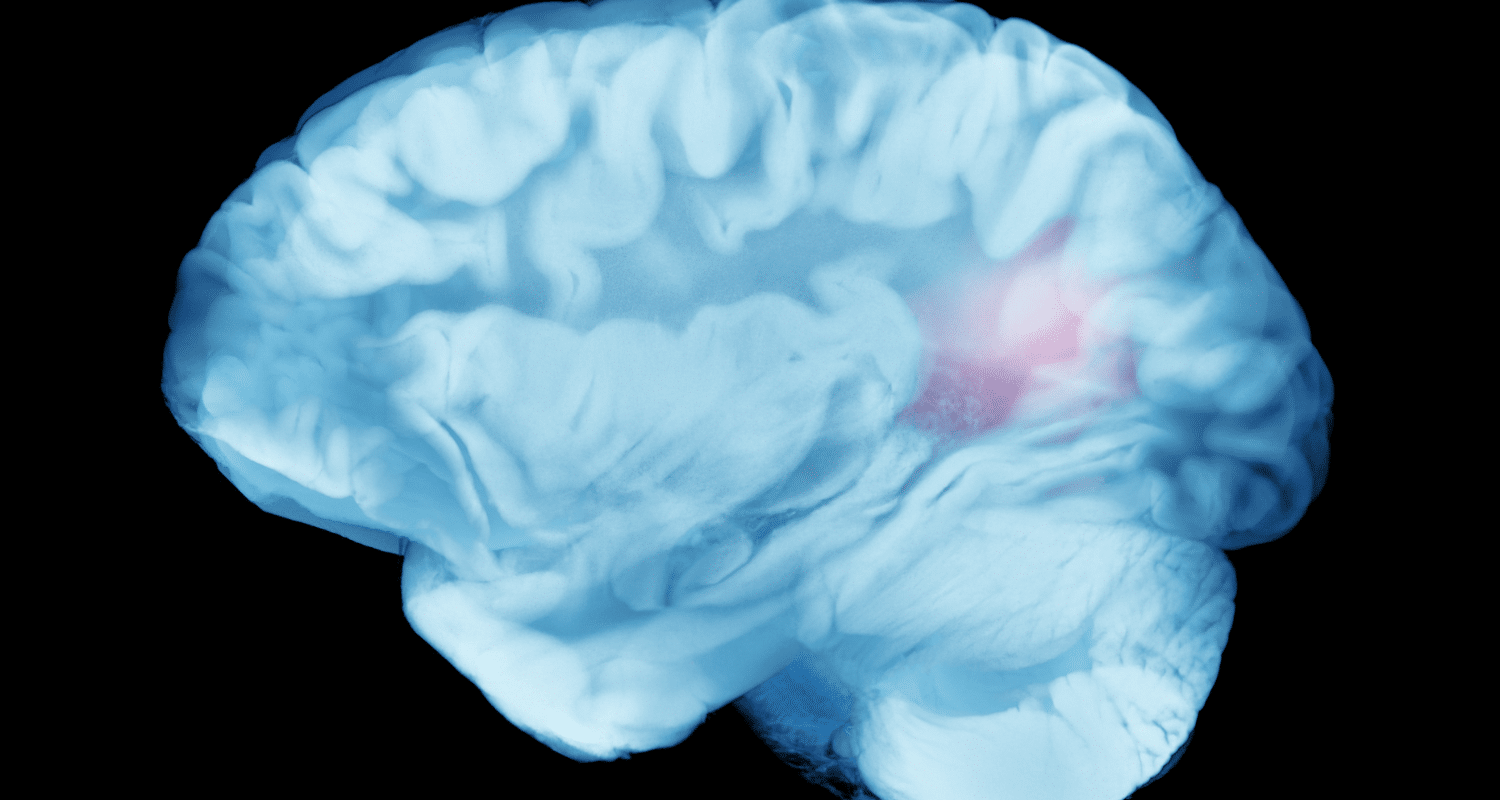 How to Prevent a Hemorrhagic Stroke