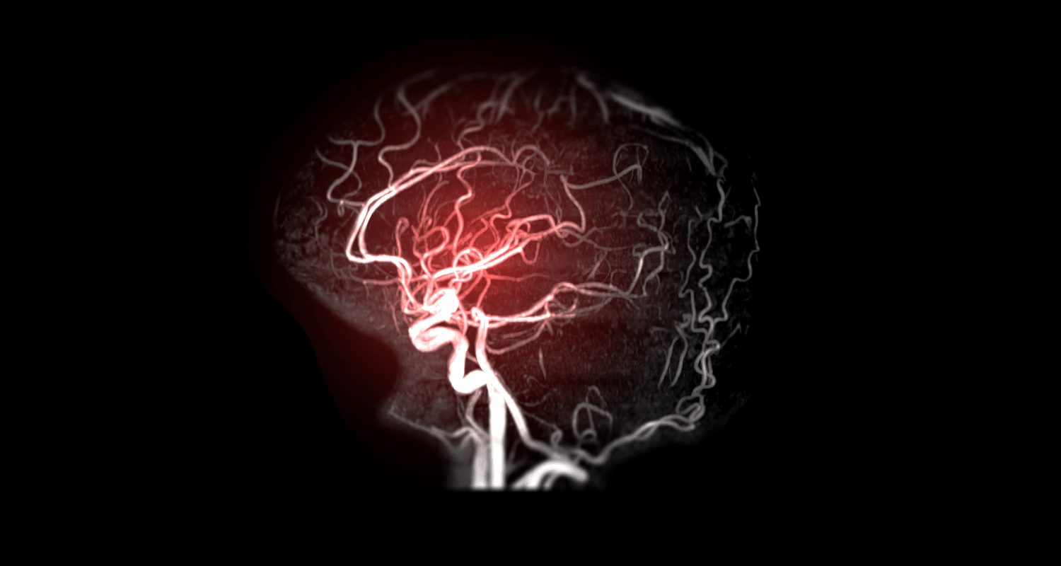 How to Prevent a Hemorrhagic Stroke