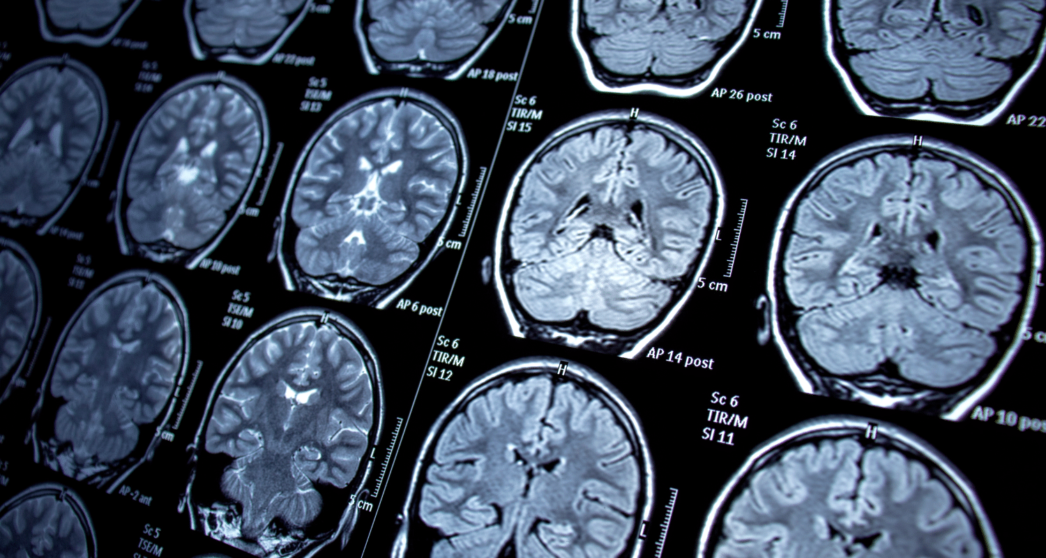 How to Prevent Seizures After Stroke