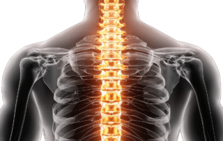 How to Prevent Spinal Stroke