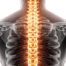 How to Prevent Spinal Stroke