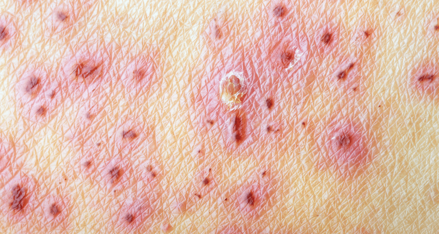 How to Prevent Stroke After Shingles