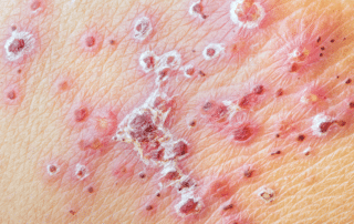 How to Prevent Stroke After Shingles