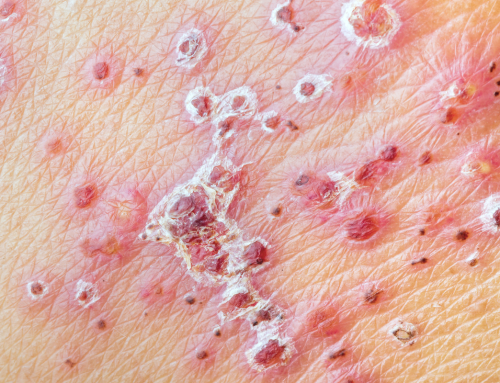 How to Prevent Stroke After Shingles