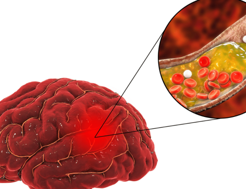 How to Prevent Ischemic Stroke: Risk Factors, Medical Care, and Daily Habits