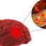 How to Prevent Ischemic Stroke